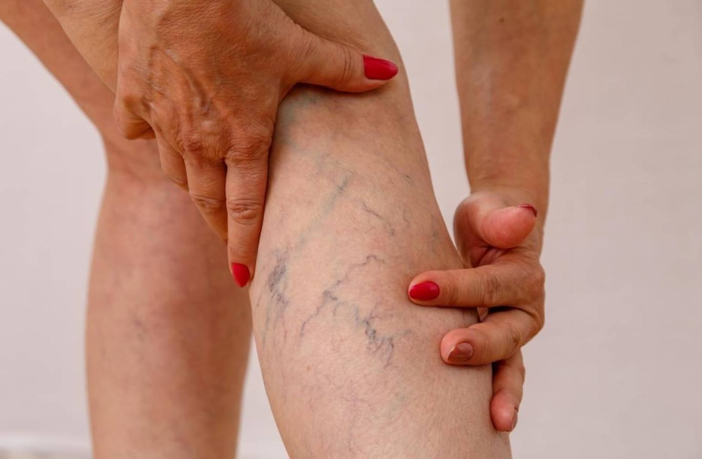dream of varicose veins